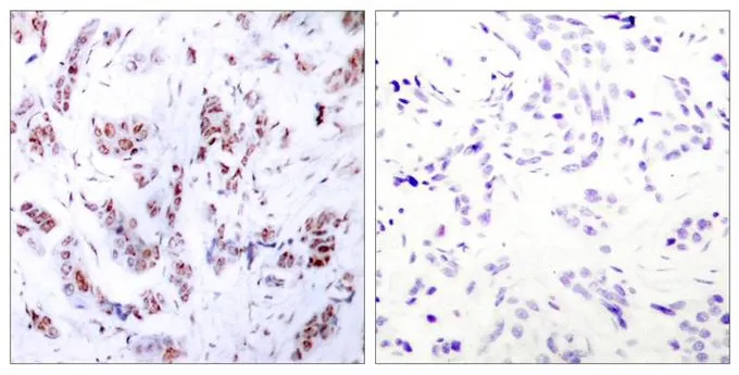 IHC-P analysis of human breast carcinoma tissue using GTX50397 MEF2A antibody. Left : Primary antibody Right : Primary antibody pre-incubated with the antigen specific peptide IHC-P analysis of human breast carcinoma tissue using GTX50397 MEF2A antibody. Left : Primary antibody Right : Primary antibody pre-incubated with the antigen specific peptide