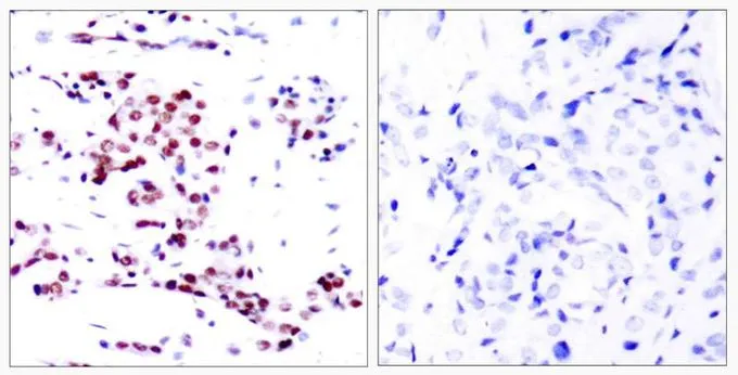 IHC-P analysis of human breast carcinoma tissue using GTX50405 STAT5A antibody. Left : Primary antibody Right : Primary antibody pre-incubated with the antigen specific peptide IHC-P analysis of human breast carcinoma tissue using GTX50405 STAT5A antibody. Left : Primary antibody Right : Primary antibody pre-incubated with the antigen specific peptide