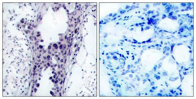 IHC-P analysis of human breast carcinoma tissue using GTX50411 PTEN antibody. Left : Primary antibody Right : Primary antibody pre-incubated with the antigen specific peptide