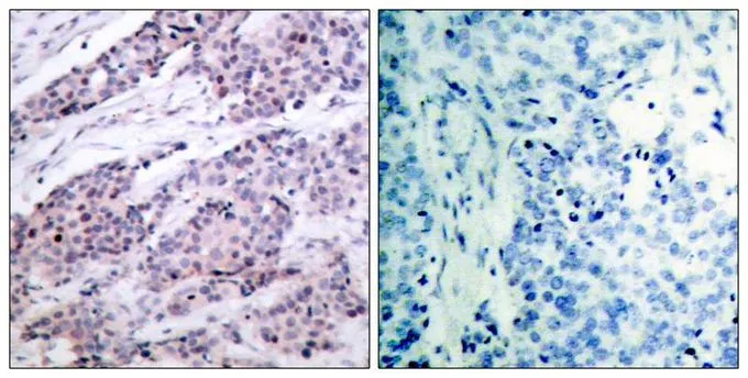 IHC-P analysis of human breast carcinoma tissue using GTX50413 Bcl-2 antibody. Left : Primary antibody Right : Primary antibody pre-incubated with the antigen specific peptide