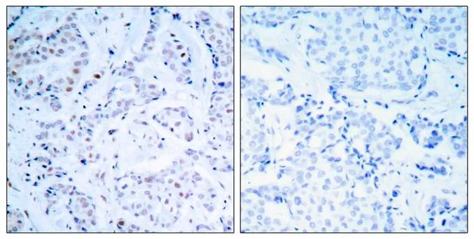 IHC-P analysis of human breast carcinoma tissue using GTX50418 Estrogen Receptor alpha antibody. Left : Primary antibody Right : Primary antibody pre-incubated with the antigen specific peptide IHC-P analysis of human breast carcinoma tissue using GTX50418 Estrogen Receptor alpha antibody. Left : Primary antibody Right : Primary antibody pre-incubated with the antigen specific peptide