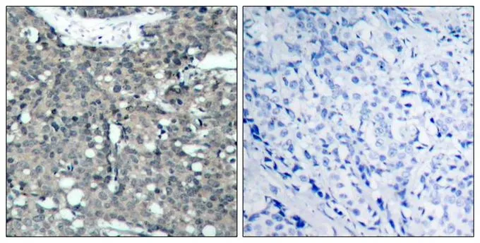 IHC-P analysis of human breast carcinoma tissue using GTX50457 Paxillin antibody. Left : Primary antibody Right : Primary antibody pre-incubated with the antigen specific peptide IHC-P analysis of human breast carcinoma tissue using GTX50457 Paxillin antibody. Left : Primary antibody Right : Primary antibody pre-incubated with the antigen specific peptide