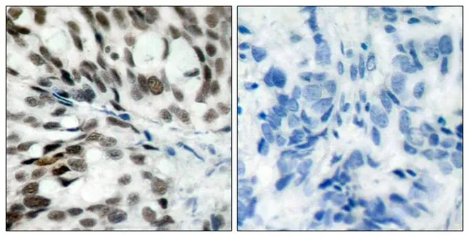 IHC-P analysis of human breast carcinoma tissue using GTX50460 Rb antibody. Left : Primary antibody Right : Primary antibody pre-incubated with the antigen specific peptide IHC-P analysis of human breast carcinoma tissue using GTX50460 Rb antibody. Left : Primary antibody Right : Primary antibody pre-incubated with the antigen specific peptide