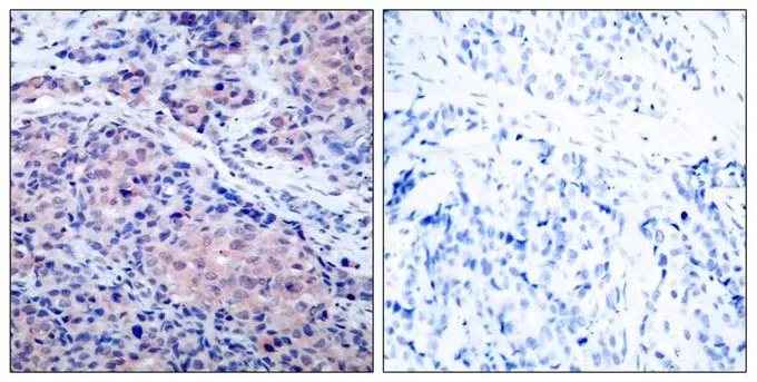 IHC-P analysis of human breast carcinoma tissue using GTX50468 IKB alpha antibody. Left : Primary antibody Right : Primary antibody pre-incubated with the antigen specific peptide
