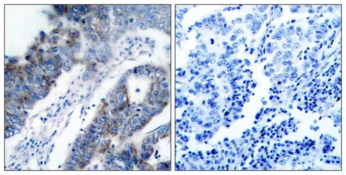 IHC-P analysis of human breast carcinoma tissue using GTX50471 ASK1 antibody. Left : Primary antibody Right : Primary antibody pre-incubated with the antigen specific peptide