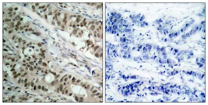 IHC-P analysis of human breast carcinoma tissue using GTX50482 FOXO1 antibody. Left : Primary antibody Right : Primary antibody pre-incubated with the antigen specific peptide