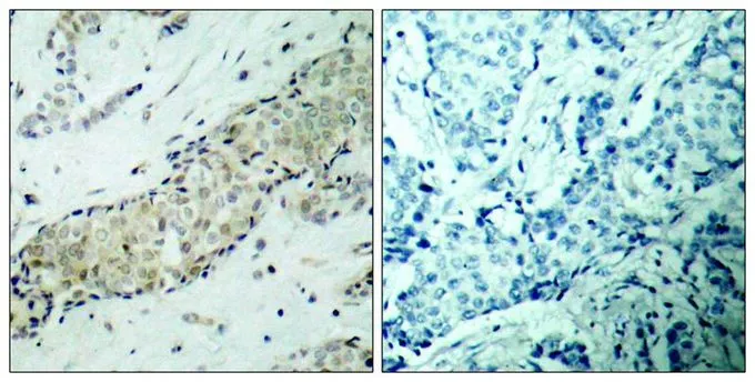 IHC-P analysis of human breast carcinoma tissue using GTX50485 HDAC5 antibody. Left : Primary antibody Right : Primary antibody pre-incubated with the antigen specific peptide IHC-P analysis of human breast carcinoma tissue using GTX50485 HDAC5 antibody. Left : Primary antibody Right : Primary antibody pre-incubated with the antigen specific peptide