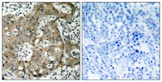 IHC-P analysis of human breast carcinoma tissue using GTX50499 FOXO1 antibody. Left : Primary antibody Right : Primary antibody pre-incubated with the antigen specific peptide IHC-P analysis of human breast carcinoma tissue using GTX50499 FOXO1 antibody. Left : Primary antibody Right : Primary antibody pre-incubated with the antigen specific peptide