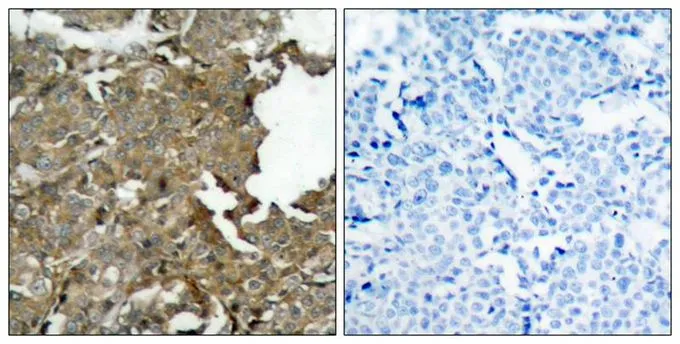 IHC-P analysis of human breast carcinoma tissue using GTX50502 Cofilin antibody. Left : Primary antibody Right : Primary antibody pre-incubated with the antigen specific peptide IHC-P analysis of human breast carcinoma tissue using GTX50502 Cofilin antibody. Left : Primary antibody Right : Primary antibody pre-incubated with the antigen specific peptide