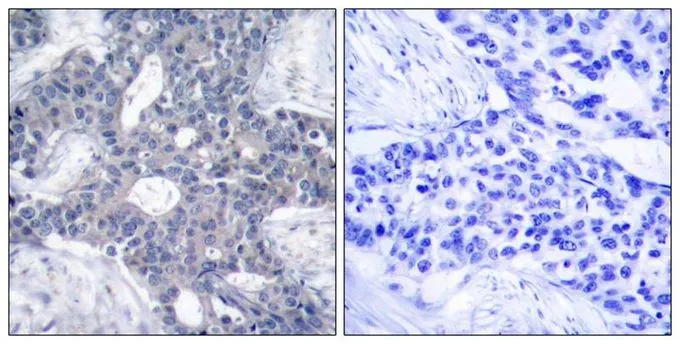 IHC-P analysis of human breast carcinoma tissue using GTX50508 ZAP70 antibody. Left : Primary antibody Right : Primary antibody pre-incubated with the antigen specific peptide IHC-P analysis of human breast carcinoma tissue using GTX50508 ZAP70 antibody. Left : Primary antibody Right : Primary antibody pre-incubated with the antigen specific peptide