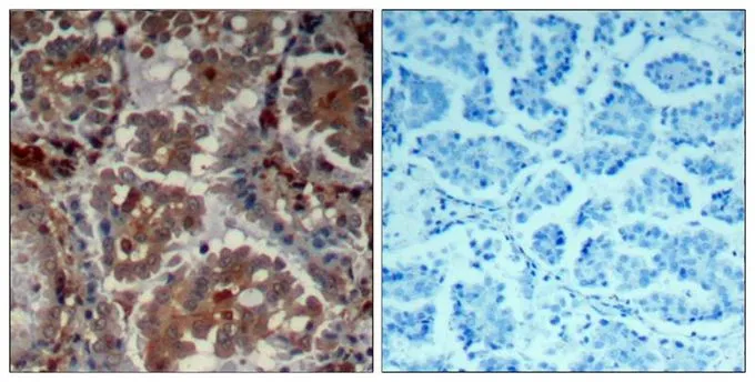 IHC-P analysis of human lung carcinoma tissue using GTX50541 mTOR antibody. Left : Primary antibody Right : Primary antibody pre-incubated with the antigen specific peptide