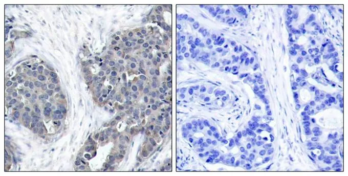 IHC-P analysis of human breast carcinoma tissue using GTX50545 Stathmin 1 antibody. Left : Primary antibody Right : Primary antibody pre-incubated with the antigen specific peptide