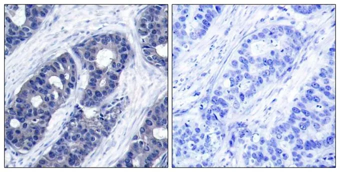 IHC-P analysis of human breast carcinoma tissue using GTX50550 IRS1 antibody. Left : Primary antibody Right : Primary antibody pre-incubated with the antigen specific peptide