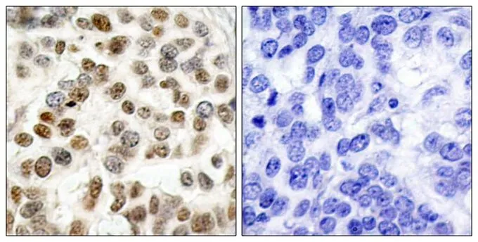 IHC-P analysis of human breast carcinoma tissue using GTX50557 BRCA1 antibody. Left : Primary antibody Right : Primary antibody pre-incubated with the antigen specific peptide IHC-P analysis of human breast carcinoma tissue using GTX50557 BRCA1 antibody. Left : Primary antibody Right : Primary antibody pre-incubated with the antigen specific peptide