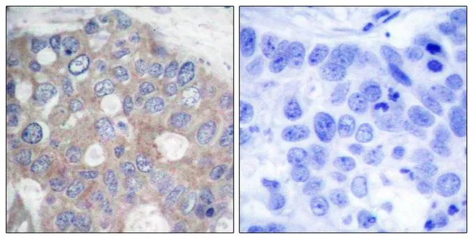 IHC-P analysis of human breast carcinoma tissue using GTX50567 p70 S6K antibody. Left : Primary antibody Right : Primary antibody pre-incubated with the antigen specific peptide IHC-P analysis of human breast carcinoma tissue using GTX50567 p70 S6K antibody. Left : Primary antibody Right : Primary antibody pre-incubated with the antigen specific peptide