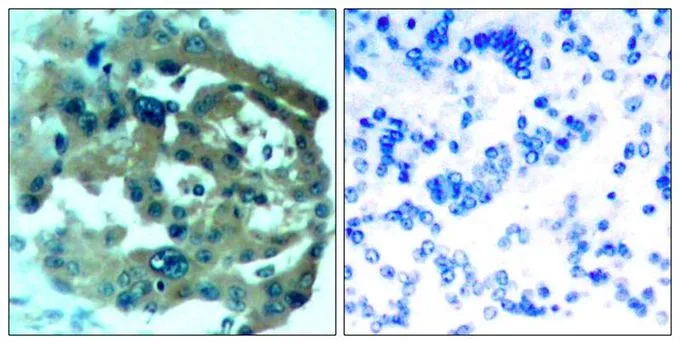 IHC-P analysis of human lung carcinoma tissue using GTX50579 Merlin antibody. Left : Primary antibody Right : Primary antibody pre-incubated with the antigen specific peptide IHC-P analysis of human lung carcinoma tissue using GTX50579 Merlin antibody. Left : Primary antibody Right : Primary antibody pre-incubated with the antigen specific peptide