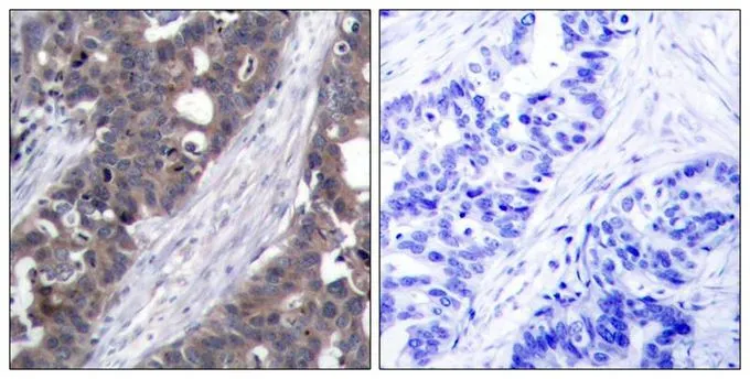 IHC-P analysis of human breast carcinoma tissue using GTX50582 p70 S6K antibody. Left : Primary antibody Right : Primary antibody pre-incubated with the antigen specific peptide