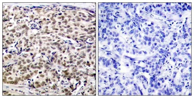 IHC-P analysis of human breast carcinoma tissue using GTX50586 CREB antibody. Left : Primary antibody Right : Primary antibody pre-incubated with the antigen specific peptide IHC-P analysis of human breast carcinoma tissue using GTX50586 CREB antibody. Left : Primary antibody Right : Primary antibody pre-incubated with the antigen specific peptide
