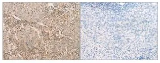 IHC-P analysis of human cervical cancer tissue using GTX50590 eIF2 alpha antibody. Left : Primary antibody Right : Primary antibody pre-incubated with the antigen specific peptide Dilution : 1:20