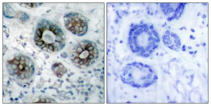 IHC-P analysis of human breast carcinoma tissue using GTX50592 GAP43 antibody. Left : Primary antibody Right : Primary antibody pre-incubated with the antigen specific peptide