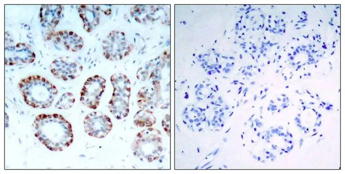 IHC-P analysis of human breast carcinoma tissue using GTX50597 Bim antibody. Left : Primary antibody Right : Primary antibody pre-incubated with the antigen specific peptide IHC-P analysis of human breast carcinoma tissue using GTX50597 Bim antibody. Left : Primary antibody Right : Primary antibody pre-incubated with the antigen specific peptide