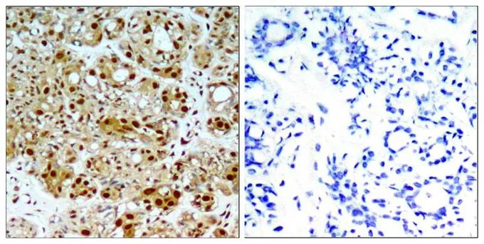 IHC-P analysis of human breast carcinoma tissue using GTX50607 HSP90 beta antibody. Left : Primary antibody Right : Primary antibody pre-incubated with the antigen specific peptide