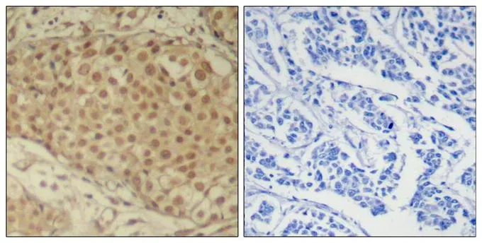 IHC-P analysis of human breast carcinoma tissue using GTX50627 SMAD2 antibody. Left : Primary antibody Right : Primary antibody pre-incubated with the antigen specific peptide IHC-P analysis of human breast carcinoma tissue using GTX50627 SMAD2 antibody. Left : Primary antibody Right : Primary antibody pre-incubated with the antigen specific peptide