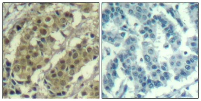 IHC-P analysis of human breast carcinoma tissue using GTX50648 AKT1 antibody. Left : Primary antibody Right : Primary antibody pre-incubated with the antigen specific peptide