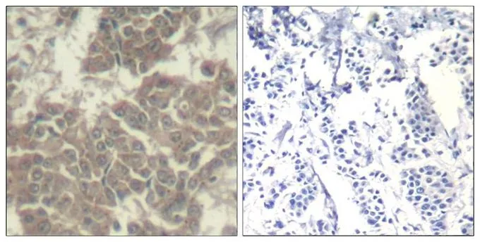 IHC-P analysis of human breast carcinoma tissue using GTX50657 JAK2 antibody. Left : Primary antibody Right : Primary antibody pre-incubated with the antigen specific peptide IHC-P analysis of human breast carcinoma tissue using GTX50657 JAK2 antibody. Left : Primary antibody Right : Primary antibody pre-incubated with the antigen specific peptide