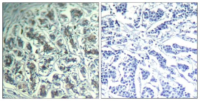 IHC-P analysis of human breast carcinoma tissue using GTX50658 PLCG1 antibody. Left : Primary antibody Right : Primary antibody pre-incubated with the antigen specific peptide IHC-P analysis of human breast carcinoma tissue using GTX50658 PLCG1 antibody. Left : Primary antibody Right : Primary antibody pre-incubated with the antigen specific peptide