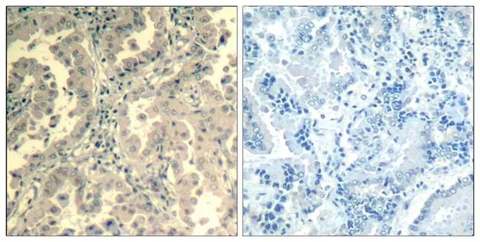 IHC-P analysis of human lung carcinoma tissue using GTX50661 STAT2 antibody. Left : Primary antibody Right : Primary antibody pre-incubated with the antigen specific peptide IHC-P analysis of human lung carcinoma tissue using GTX50661 STAT2 antibody. Left : Primary antibody Right : Primary antibody pre-incubated with the antigen specific peptide