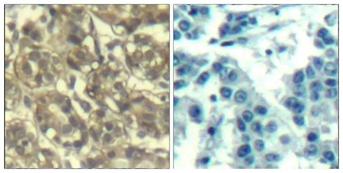 IHC-P analysis of human breast carcinoma tissue using GTX50663 Cyclin B1 antibody. Left : Primary antibody Right : Primary antibody pre-incubated with the antigen specific peptide
