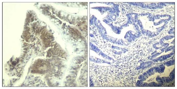 IHC-P analysis of human colon carcinoma tissue using GTX50664 CDK6 antibody. Left : Primary antibody Right : Primary antibody pre-incubated with the antigen specific peptide