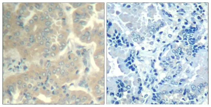 IHC-P analysis of human lung carcinoma tissue using GTX50666 FAK antibody. Left : Primary antibody Right : Primary antibody pre-incubated with the antigen specific peptide IHC-P analysis of human lung carcinoma tissue using GTX50666 FAK antibody. Left : Primary antibody Right : Primary antibody pre-incubated with the antigen specific peptide