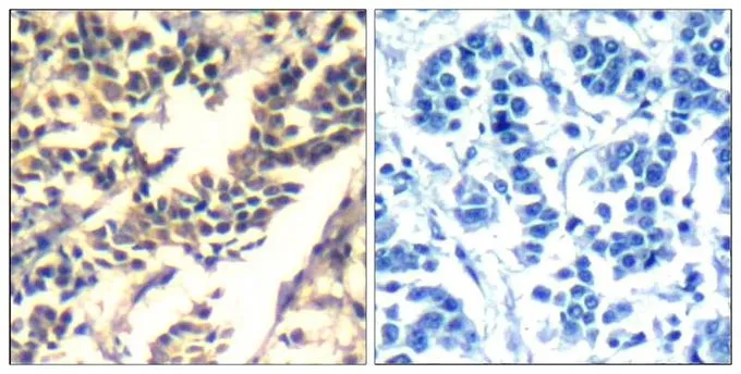 IHC-P analysis of human breast carcinoma tissue using GTX50669 CBL antibody. Left : Primary antibody Right : Primary antibody pre-incubated with the antigen specific peptide IHC-P analysis of human breast carcinoma tissue using GTX50669 CBL antibody. Left : Primary antibody Right : Primary antibody pre-incubated with the antigen specific peptide
