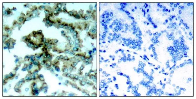 IHC-P analysis of human lung carcinoma tissue using GTX50682 PKC beta 2 (phospho Thr641) antibody.