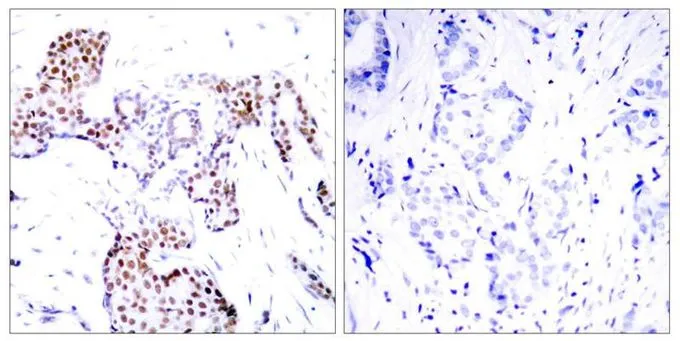 IHC-P analysis of human breast carcinoma tissue using GTX50688 ELK1 (phospho Ser389) antibody. Left : Primary antibody Right : Primary antibody pre-incubated with the antigen specific peptide IHC-P analysis of human breast carcinoma tissue using GTX50688 ELK1 (phospho Ser389) antibody. Left : Primary antibody Right : Primary antibody pre-incubated with the antigen specific peptide
