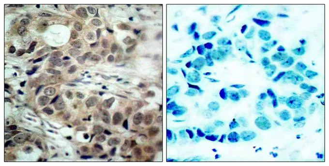 IHC-P analysis of human breast carcinoma tissue using GTX50689 CDC25C (phospho Ser216) antibody. Left : Primary antibody Right : Primary antibody pre-incubated with the antigen specific peptide