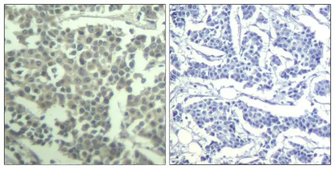 IHC-P analysis of human breast carcinoma tissue using GTX50690 c-kit (phospho Tyr936) antibody. Left : Primary antibody Right : Primary antibody pre-incubated with the antigen specific peptide IHC-P analysis of human breast carcinoma tissue using GTX50690 c-kit (phospho Tyr936) antibody. Left : Primary antibody Right : Primary antibody pre-incubated with the antigen specific peptide
