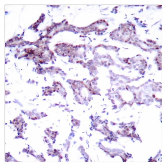 IHC-P analysis of human breast carcinoma tissue using GTX50691 ELK1 antibody.