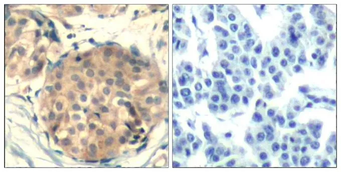 IHC-P analysis of human breast carcinoma tissue using GTX50708 c-kit antibody. Left : Primary antibody Right : Primary antibody pre-incubated with the antigen specific peptide