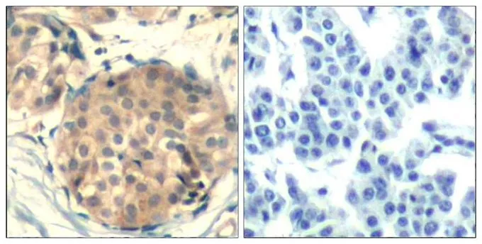 IHC-P analysis of human breast carcinoma tissue using GTX50708 c-kit antibody. Left : Primary antibody Right : Primary antibody pre-incubated with the antigen specific peptide IHC-P analysis of human breast carcinoma tissue using GTX50708 c-kit antibody. Left : Primary antibody Right : Primary antibody pre-incubated with the antigen specific peptide