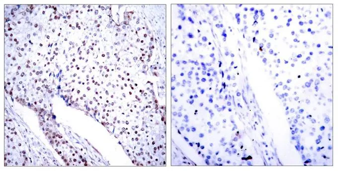 IHC-P analysis of human breast carcinoma tissue using GTX50709 STAT3 antibody.