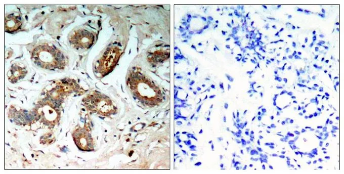 IHC-P analysis of human breast carcinoma tissue using GTX50712 14-3-3 zeta (phospho Ser58) antibody. Left : Primary antibody Right : Primary antibody pre-incubated with the antigen specific peptide