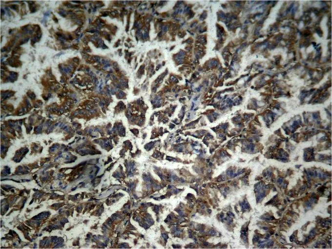 IHC-P analysis of human lung carcinoma tissue using GTX50727 beta Catenin (phospho Tyr333) antibody. IHC-P analysis of human lung carcinoma tissue using GTX50727 beta Catenin (phospho Tyr333) antibody.