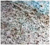 IHC-P analysis of mouse pancreatic cancer tissue sections using GTX50821 Twist1 antibody. IHC-P analysis of mouse pancreatic cancer tissue sections using GTX50821 Twist1 antibody.