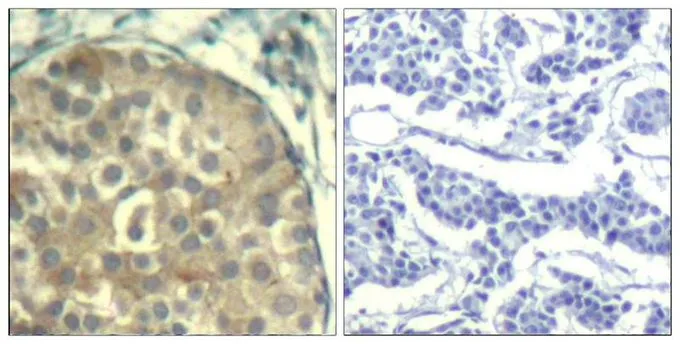 IHC-P analysis of human breast carcinoma tissue using GTX50866 Cofilin (phospho Tyr89) antibody antibody. Left : Primary antibody Right : Primary antibody pre-incubated with the antigen specific peptide IHC-P analysis of human breast carcinoma tissue using GTX50866 Cofilin (phospho Tyr89) antibody antibody. Left : Primary antibody Right : Primary antibody pre-incubated with the antigen specific peptide