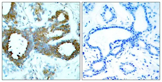 IHC-P analysis of human breast carcinoma tissue using GTX50867 PAK1 ( phospho Thr423 ) / PAK2 ( phospho Thr402 ) / PAK3 ( phospho Thr436 ) antibody. Left : Primary antibody Right : Primary antibody pre-incubated with the antigen specific peptide