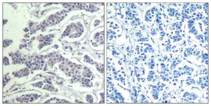 IHC-P analysis of human breast carcinoma tissue using GTX50869 AKT (phospho Tyr315) antibody. Left : Primary antibody Right : Primary antibody pre-incubated with the antigen specific peptide