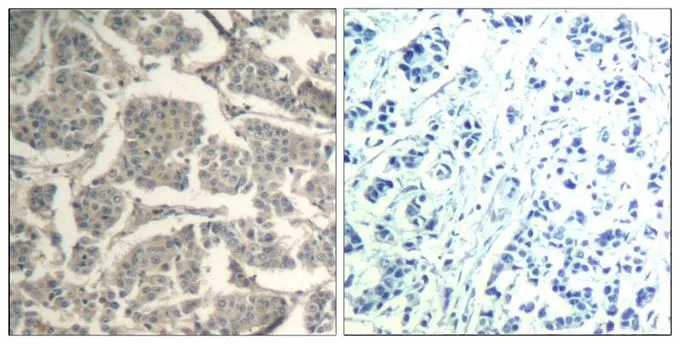 IHC-P analysis of human breast carcinoma tissue using GTX50872 Coflin1/Cofilin2 antibody. Left : Primary antibody Right : Primary antibody pre-incubated with the antigen specific peptide